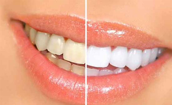 راه‌های جلوگیری از زردی دندان‌ها