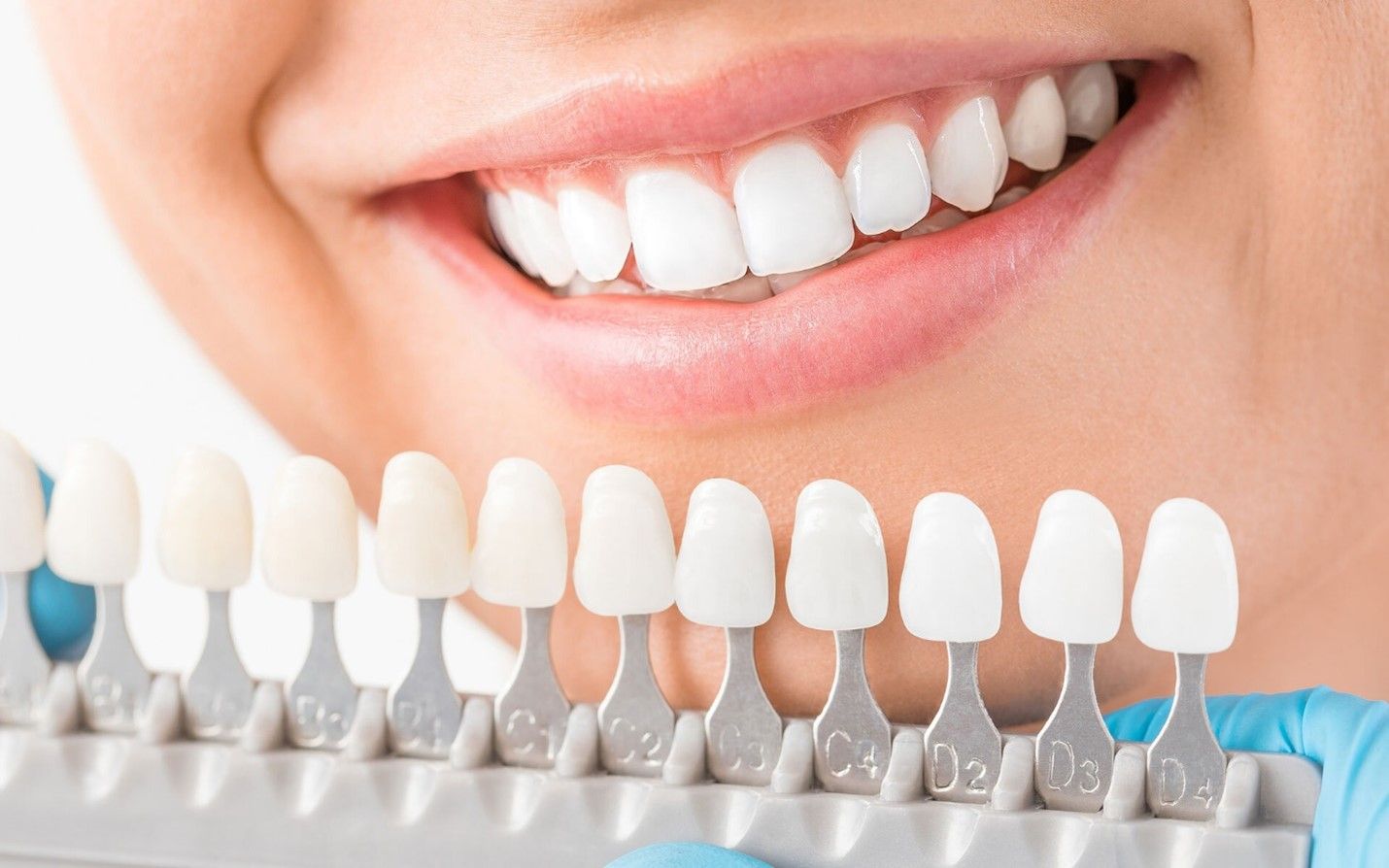 لیمینت یا کامپوزیت کدام برای دندان ایمپلنت شده مناسب تر است؟