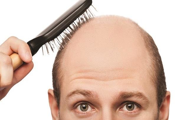 ریزش روزی چند تار مو طبیعی است؟