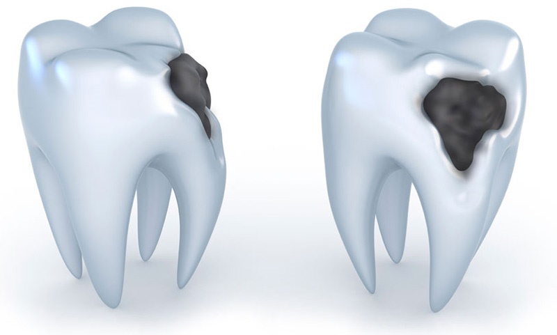 دانستنی‌هایی درباره پوسیدگی دندان