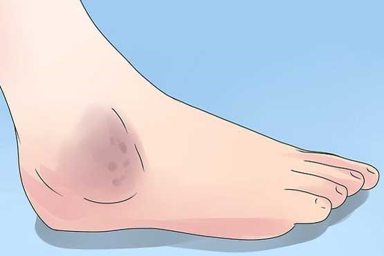 بیماری‌هایی که با ورم قوزک پا ظاهر می‌شوند