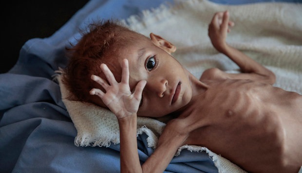 یک سوم کودکان زیر ۵سال جهان دچار سوءتغذیه هستند