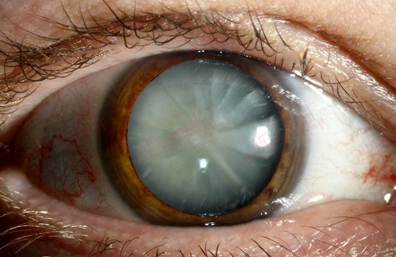 اختلال چشمی آب مروارید با بیماری قلبی مرتبط است؟