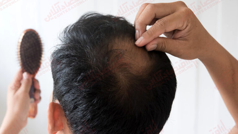 ۱۷ روش درمانی برای جلوگیری از ریزش مو برای آقایان