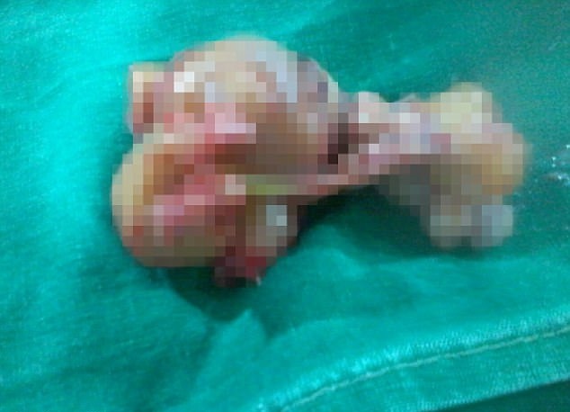 نوزادی که باردار به دنیا آمد! +عکس