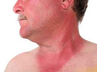 درمان سریع آفتاب سوختگی صورت و بدن با طب سنتی