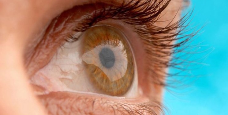 بیماری‌ های چشمی که در جوانان شایع است