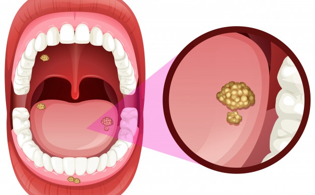 چگونه سرطان دهان را بشناسیم؟