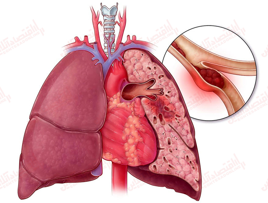 آمبولی ریه چیست؟ 