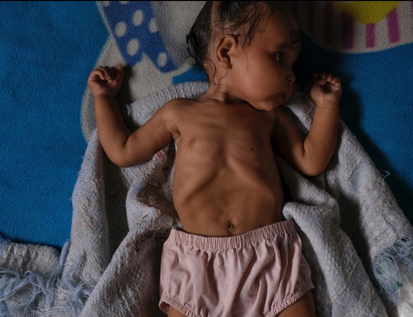 سوءتغذیه کودکان در ونزوئلا +عکس