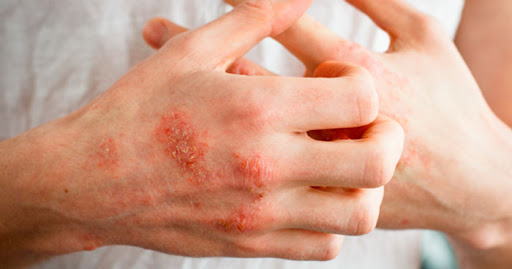 راهکار‌های طبیعی برای درمان عفونت‌ های پوستی