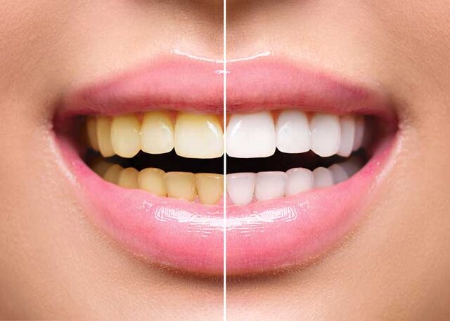 کدام سفید کننده ها برای دندان ها مجاز هستند؟