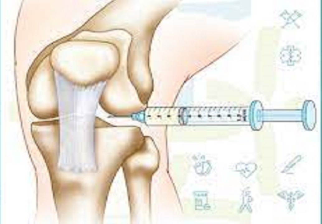تزریق مفصلی بوتاکس به درمان درد مفاصل کمک می کند