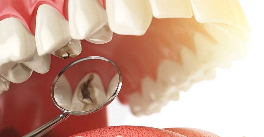 مهمترین دلایل پوسیدگی دندان