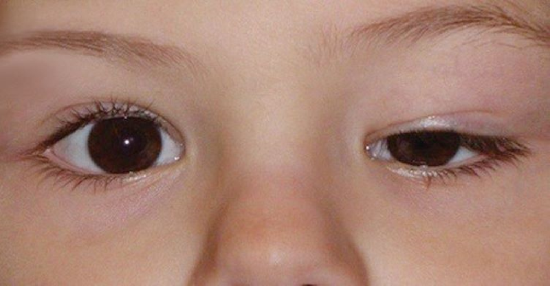علت پتوزیس یا افتادگی پلک‌ چشم چیست؟
