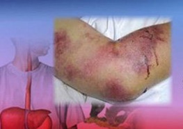 شناسایی ۶ مورد مشکوک مبتلا به تب کنگو در مازندران
