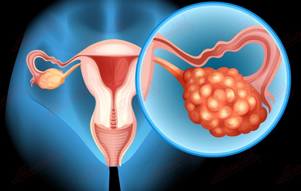 سرطان تخمدان متاستاتیک به کجا گسترش می‌ یابد؟