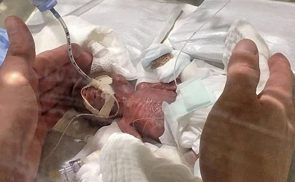 کوچک‌ترین نوزاد پسر دنیا زنده ماند +تصاویر