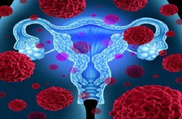آنچه که زنان باید در مورد سرطان تخمدان بدانند