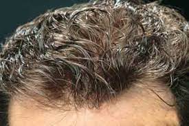 ۲۰ روش برای کنترل چربی مو و پوست سر
