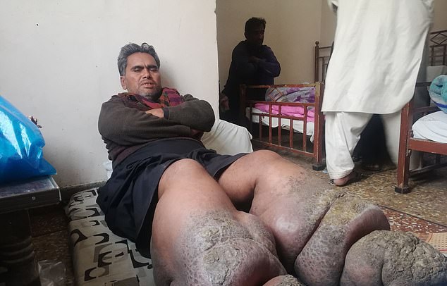 پاهای ۱۰۰کیلویی مرد پاکستانی+تصاویر