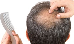 صدور مجوز برای داروی درمان ریزش موی ایرانی