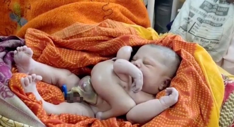 تولد نوزاد عجیب الخلقه چهار دست و پا در هند + عکس