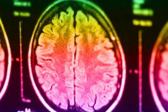 کشف اختلالات خاص مغزی در سر افراد قاتل! +عکس
