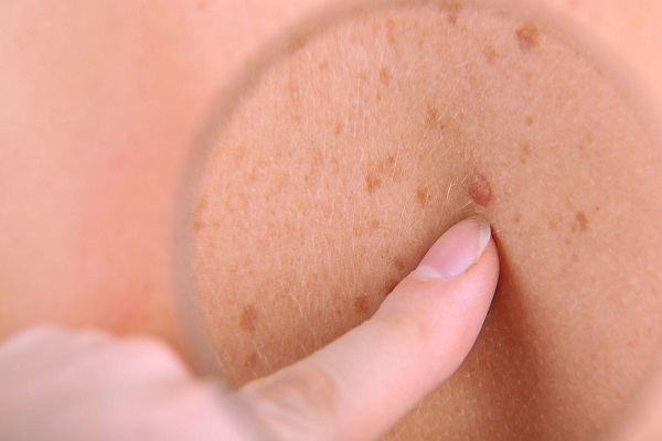 کشف درمان جدید برای سرطان پوست
